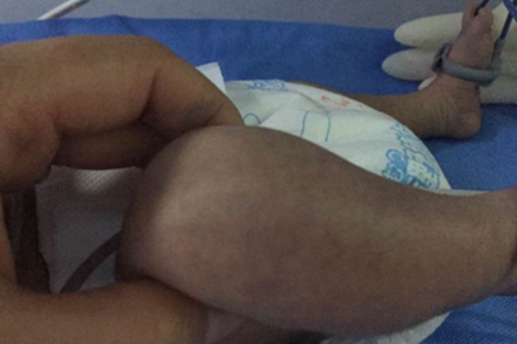 新生儿寒冷损伤综合征症状图