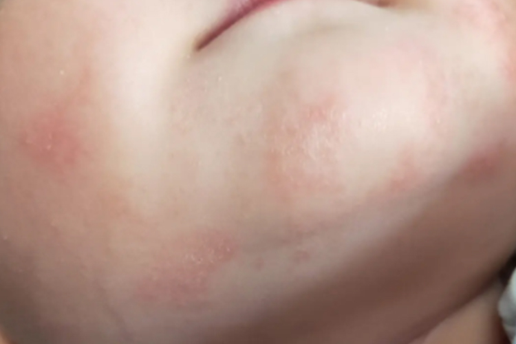 婴儿钱币状湿疹近圆形红斑图 婴儿钱币状湿疹近圆形红斑图