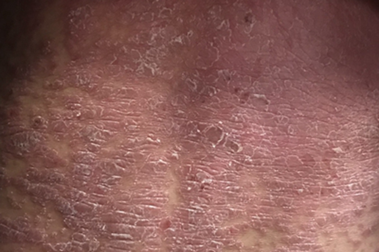 红皮病型银屑病背部红斑图 红皮病型银屑病背部红斑图