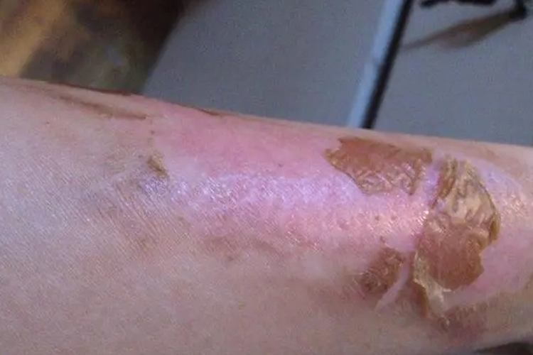 浅二度烫伤6天恢复图