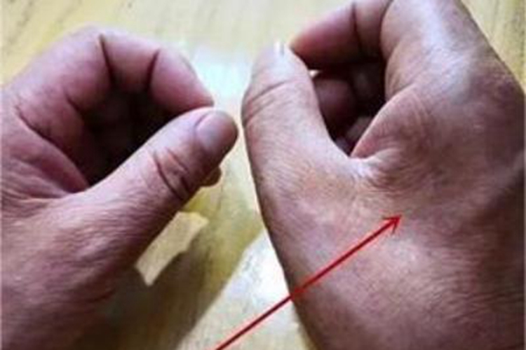 肌肉萎缩手部症状图