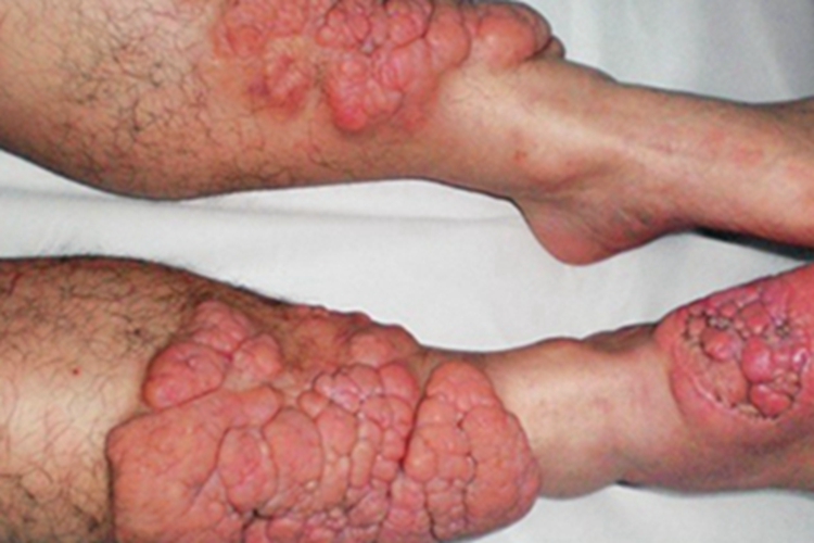 胫前黏液性水肿小腿症状图