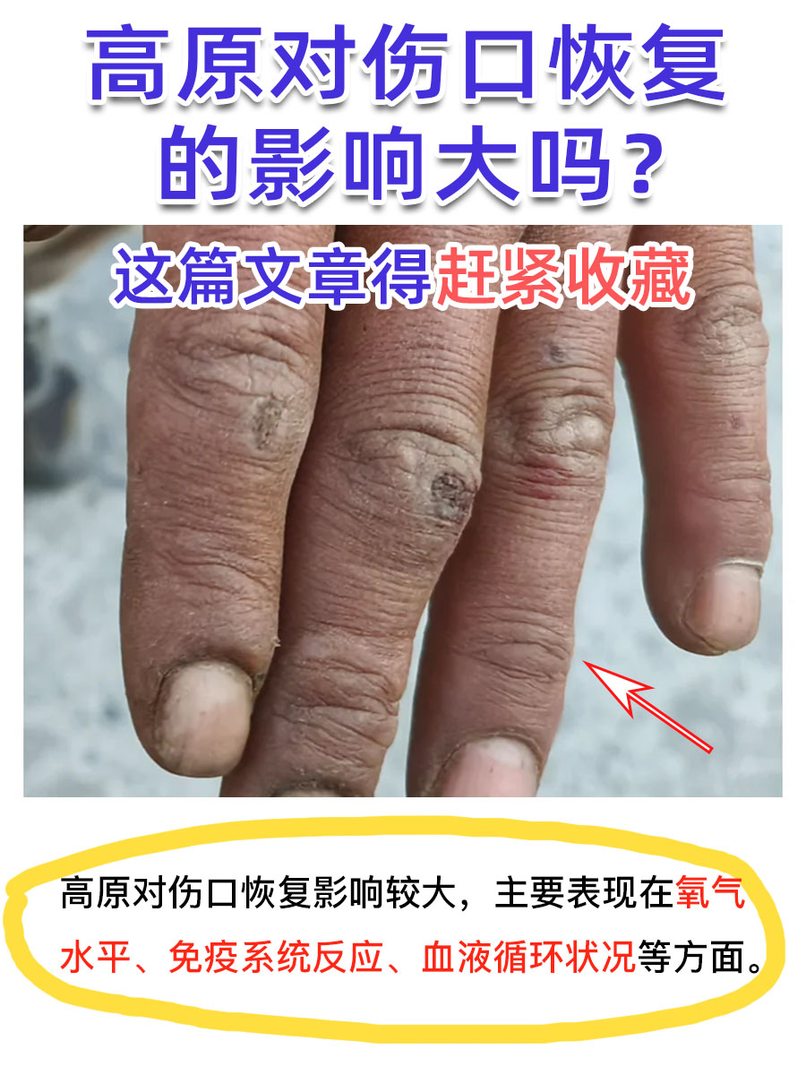 高原对伤口恢复的影响大吗？这篇文章得赶紧收藏