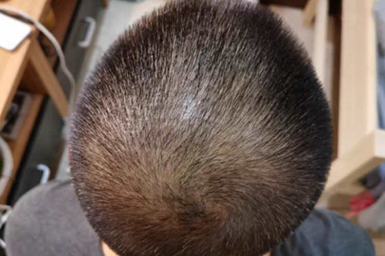 雄激素性脱发头顶毛发变少图