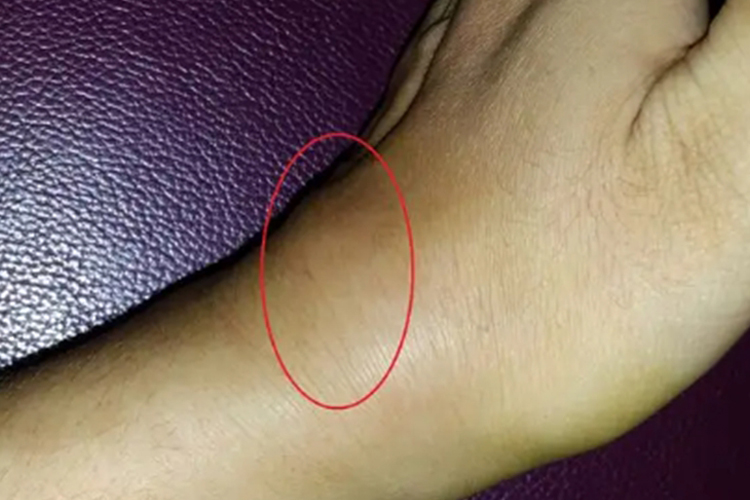 手骨膜炎水肿图