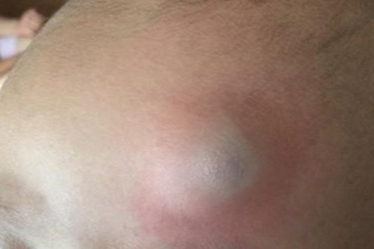 皮下血肿头皮红肿图 皮下血肿头皮红肿图