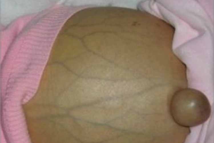 血吸虫病腹部膨隆图