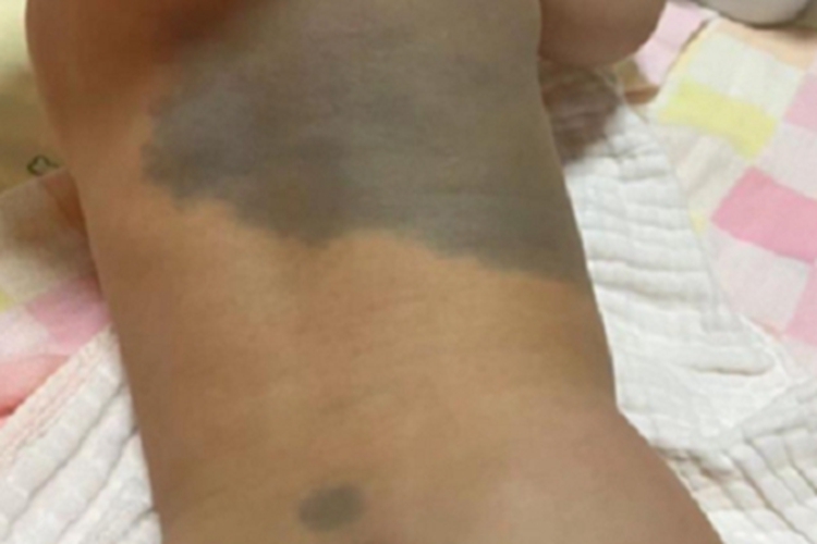 伊藤痣背部有大片青色斑块图