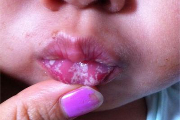 新生儿鹅口疮嘴唇症状图 新生儿鹅口疮嘴唇症状图