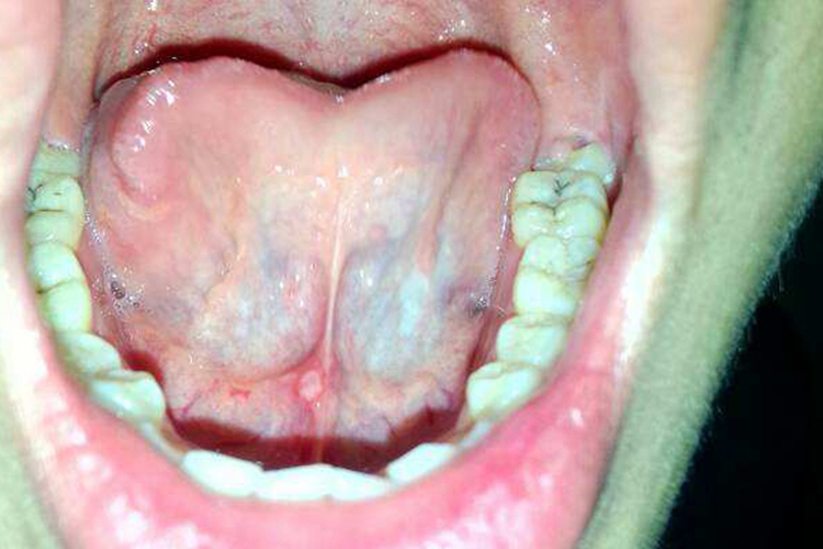 尖锐湿疣白色疙瘩图