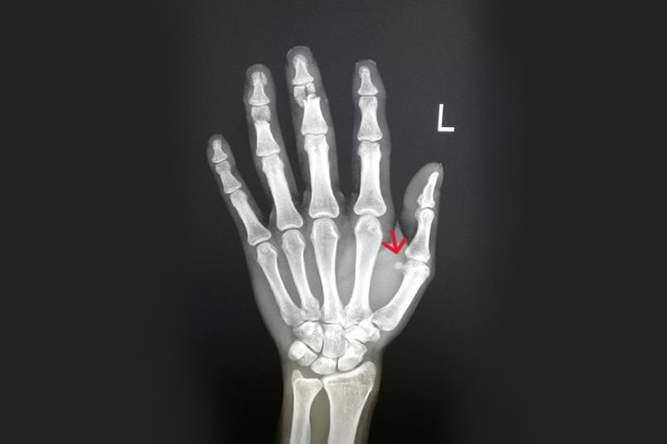 拇指内侧籽骨图 拇指内侧籽骨图