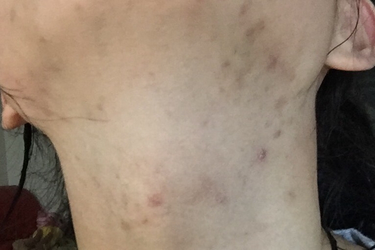 脖子炎症色素沉着图 脖子炎症色素沉着图