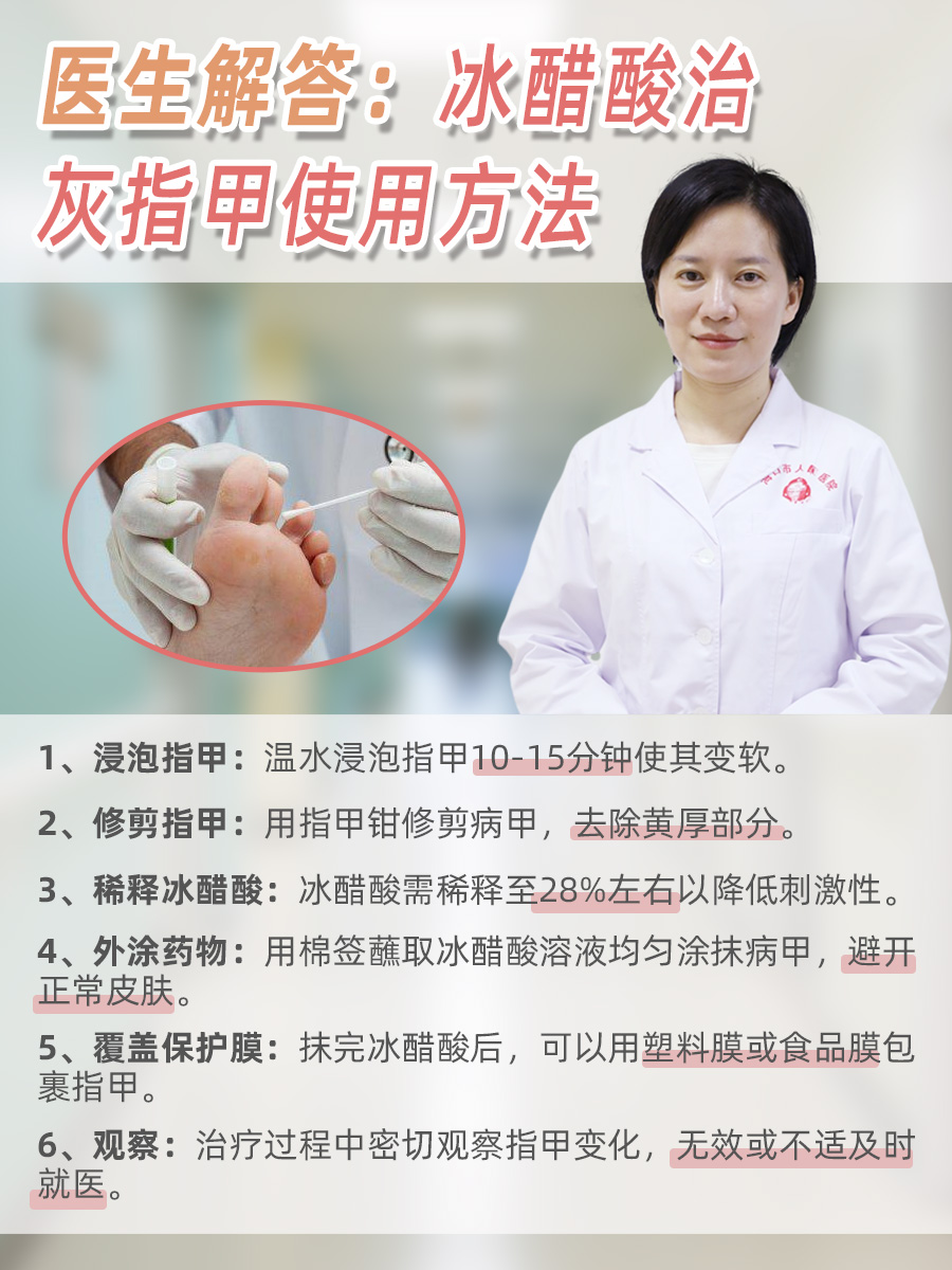 医生解答：冰醋酸治灰指甲使用方法