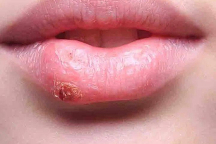 急性光化性唇炎肿结痂图
