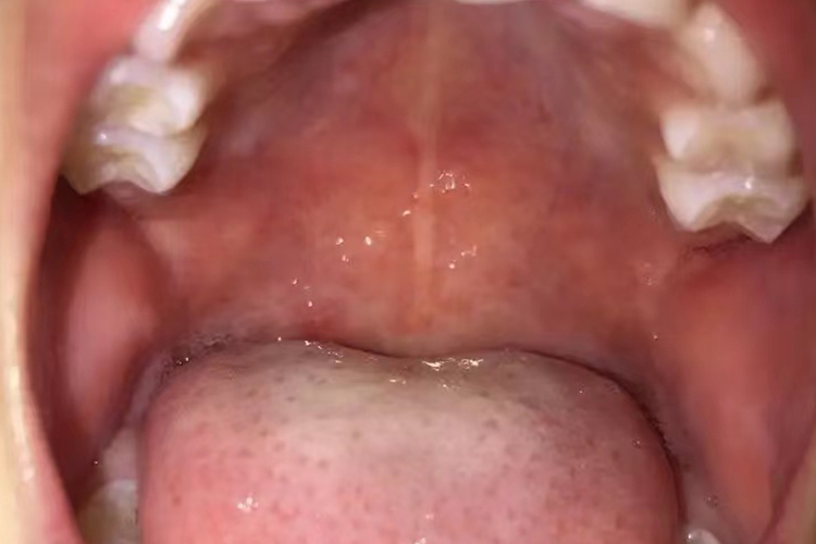 手足口病口腔恢复图 手足口病口腔恢复图