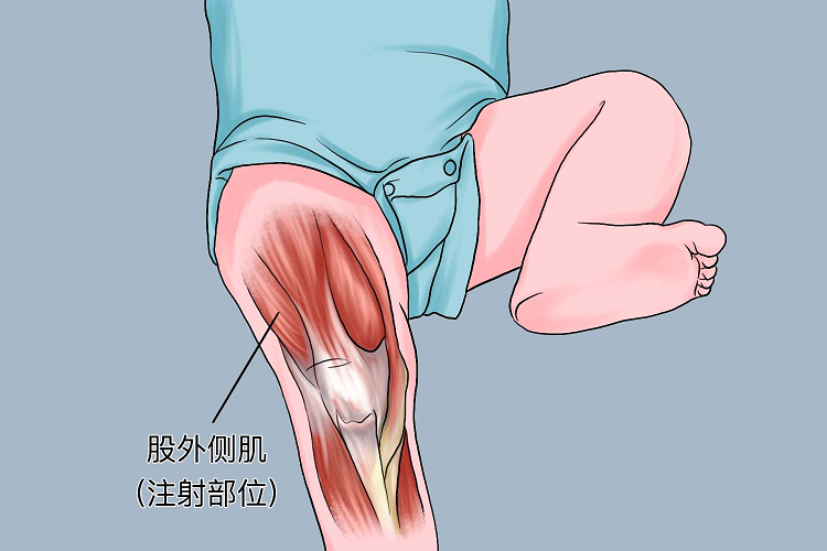 新生儿股外侧肌注射部位图