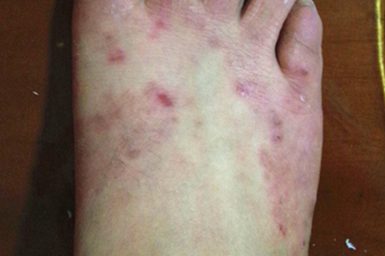 色素性痒疹脚背丘疹图 色素性痒疹脚背丘疹图
