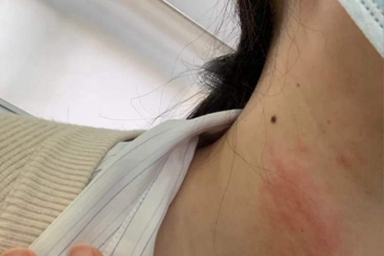皮肤过敏红肿颈部轻度红肿图 皮肤过敏红肿颈部轻度红肿图