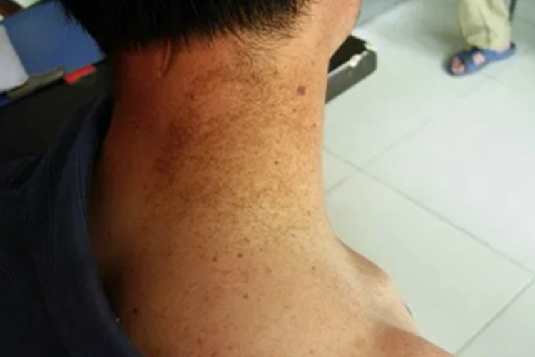 雀斑样痣颈部斑图