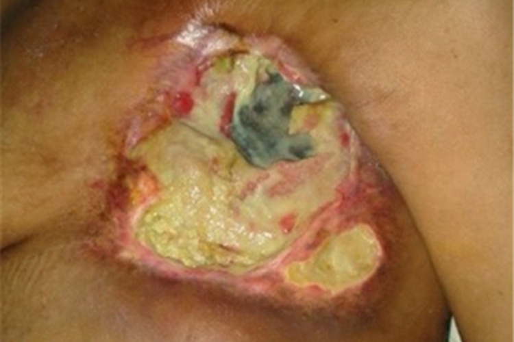 乳腺癌乳房结节图