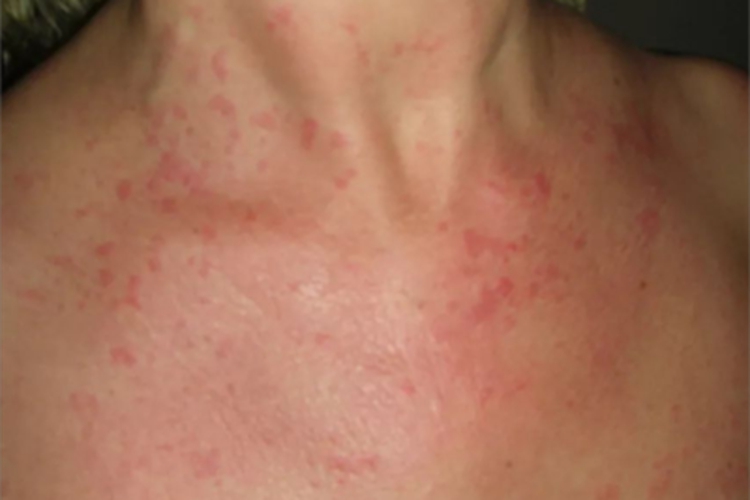 成人Still病胸部症状图 成人Still病胸部症状图