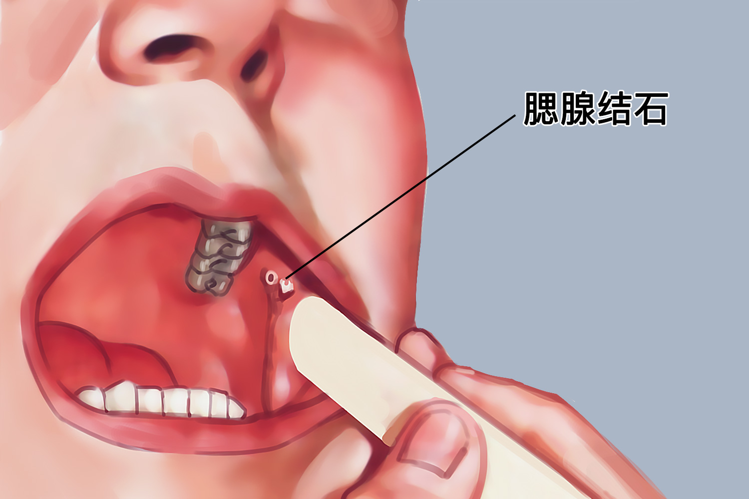 腮腺结石图 腮腺结石图