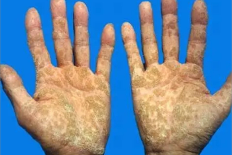 钱币状掌跖角化病手掌皮肤发黄图 钱币状掌跖角化病手掌皮肤发黄图