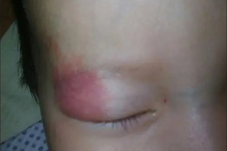 鲜红斑痣红色胎记图 鲜红斑痣红色胎记图