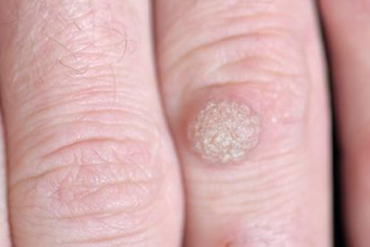 寻常疣白色疙瘩图 寻常疣白色疙瘩图