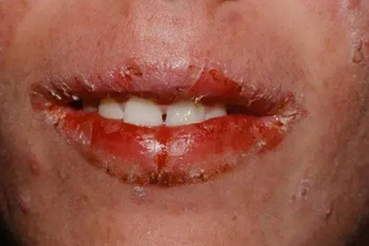 慢性唇炎嘴唇脱皮图