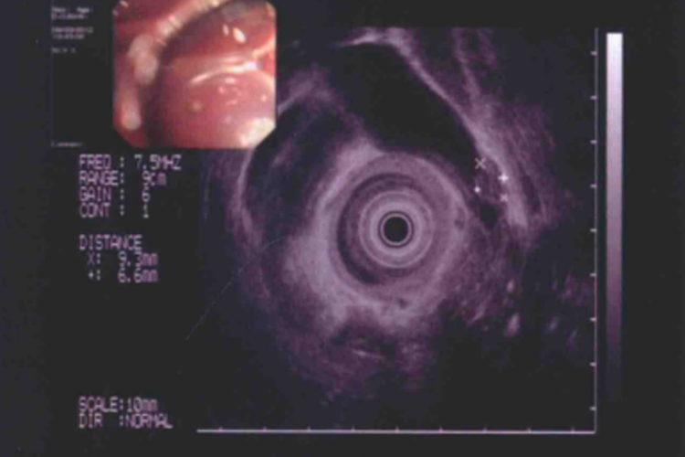 胆囊腺肌症超声图 胆囊腺肌症超声图
