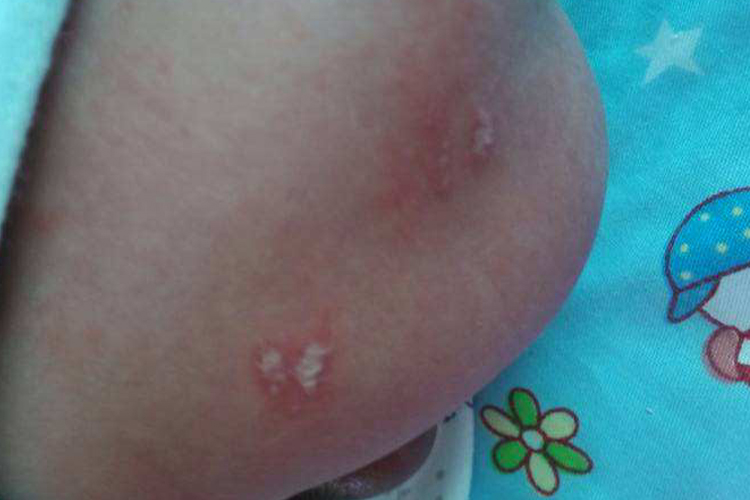 新生儿传染性软疣图 新生儿传染性软疣图