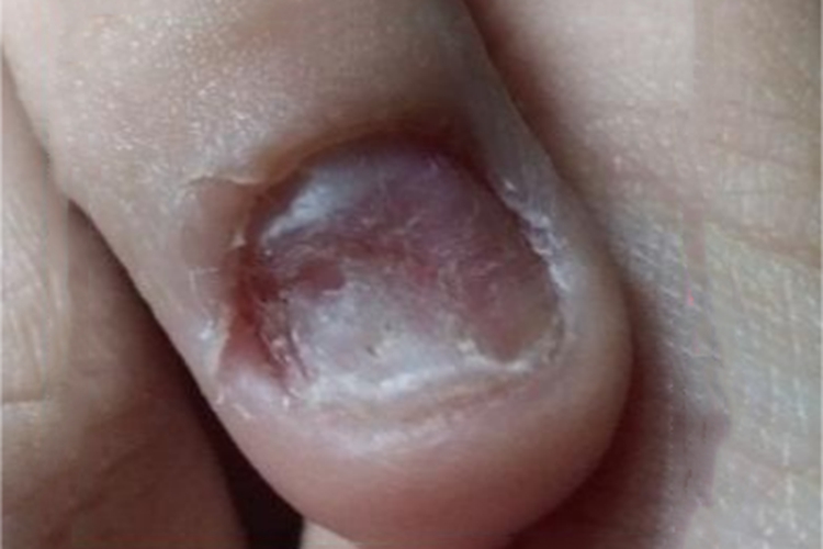 甲萎缩手指甲有坑图