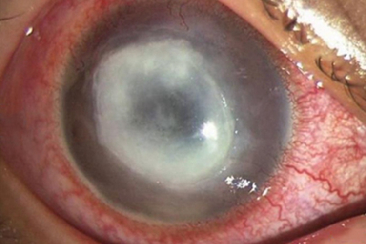 角膜脂质变性眼球白斑图