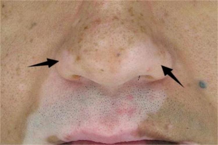 进展期节段型白癜风鼻翼症状图