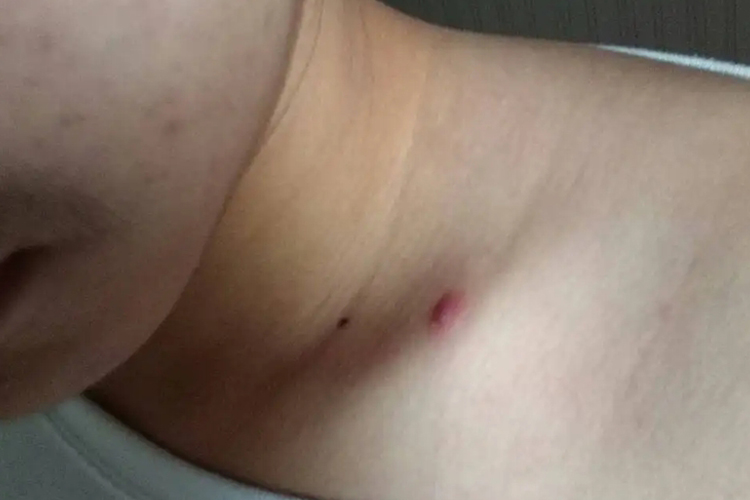 左锁骨上结节性痒疹图