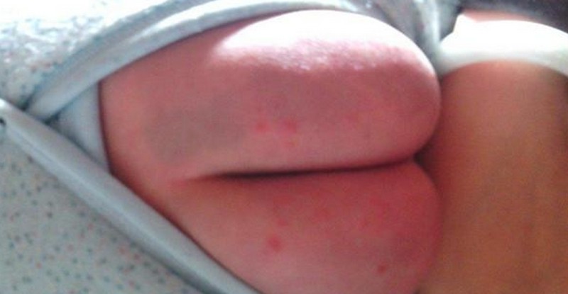 小儿肛门湿疹初期图片
