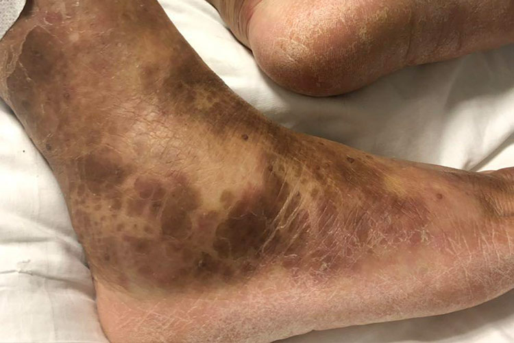 淤积性皮炎图 淤积性皮炎图