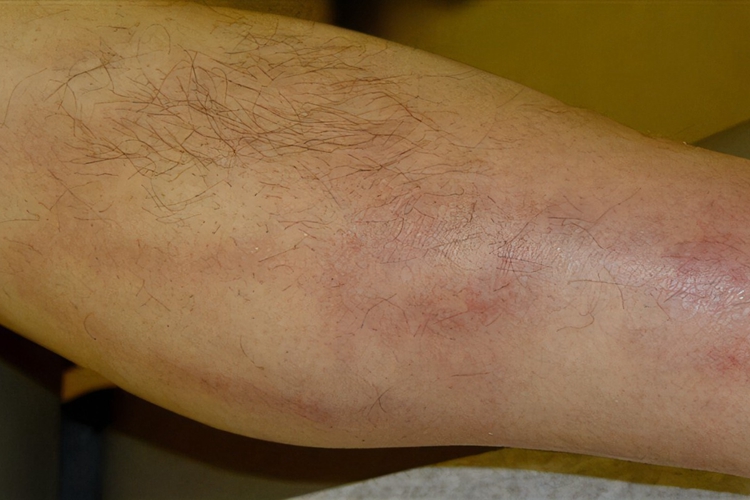 血栓性浅静脉炎起硬块图