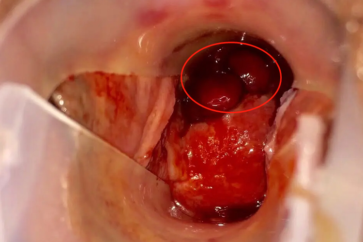 子宫息肉有红疙瘩图