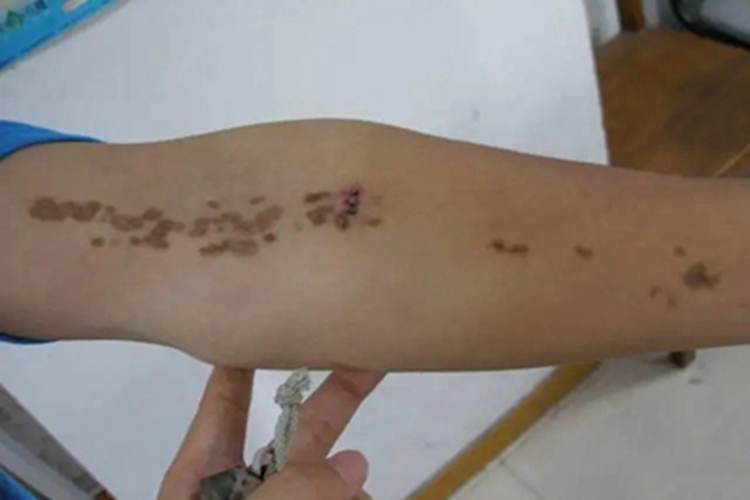 汗孔角化病长斑图 汗孔角化病长斑图