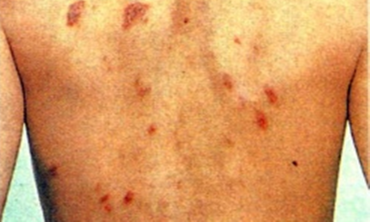后背玫瑰糠疹图 后背玫瑰糠疹图