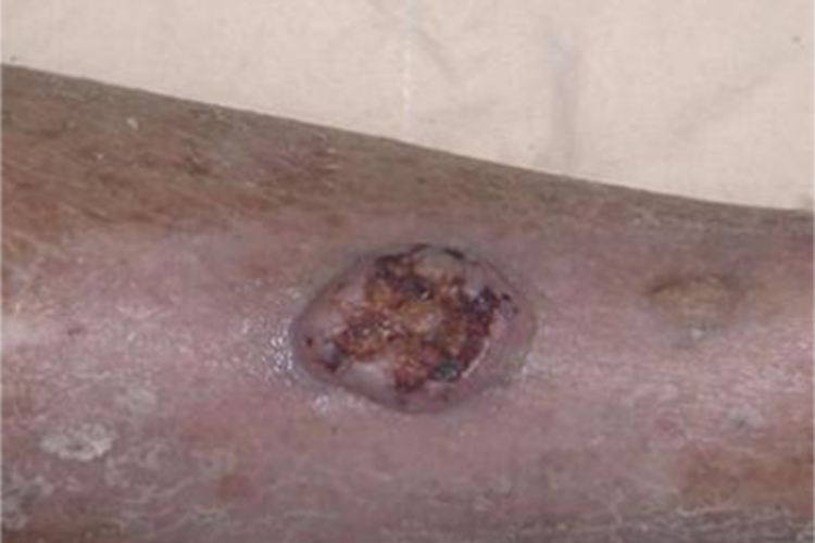 皮肤基底细胞癌溃疡图