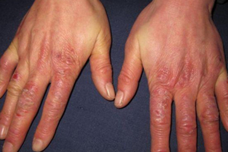 寒冷性多形红斑手指红斑图