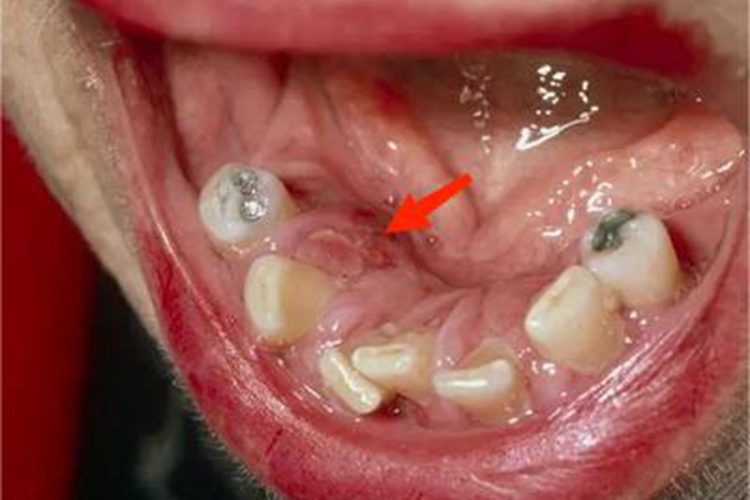 口腔梅毒糜烂图