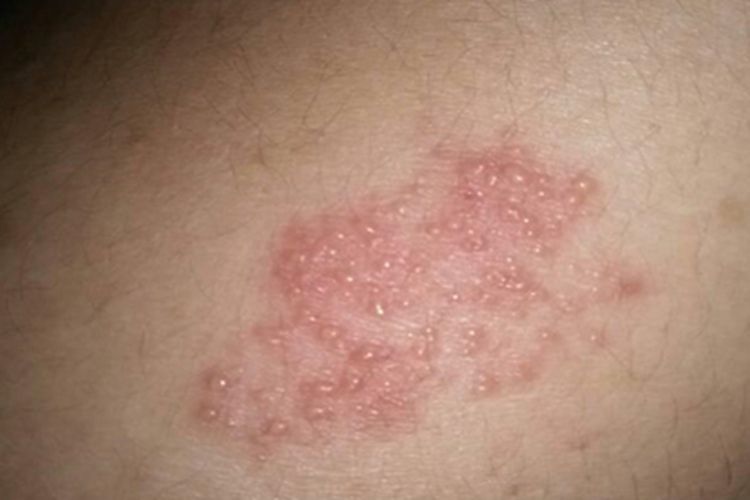 铜绿假单胞菌毛囊炎小水疱图 铜绿假单胞菌毛囊炎小水疱图