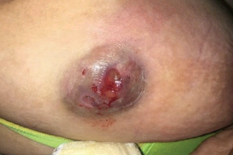 透明细胞汗腺癌腹部症状图