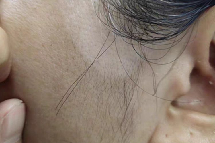 白癜风耳前白斑图