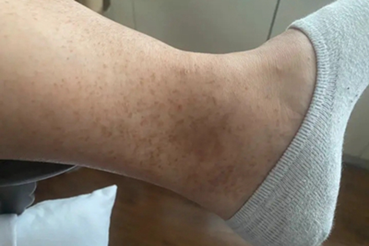 网状肢端色素沉着脚踝症状图