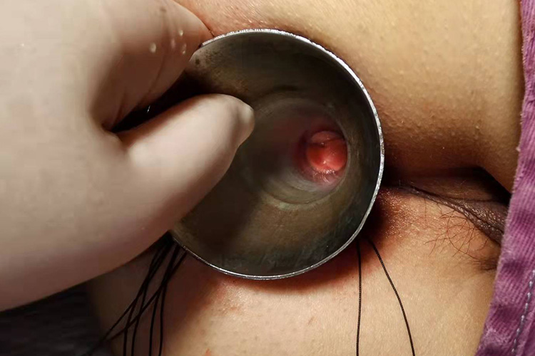 Ⅰ度内痔痔核未脱出图